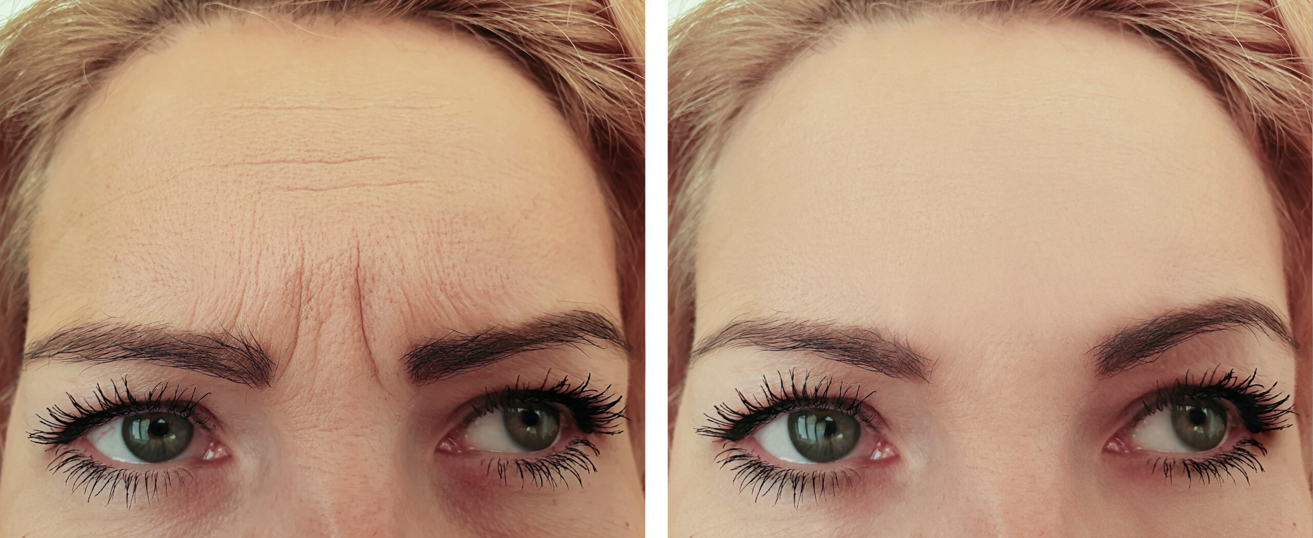 Woman,Face,Wrinkles,Before,And,After,Procedures