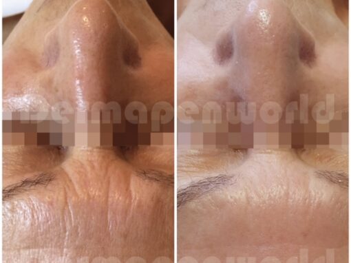 Dermapen before and after 3