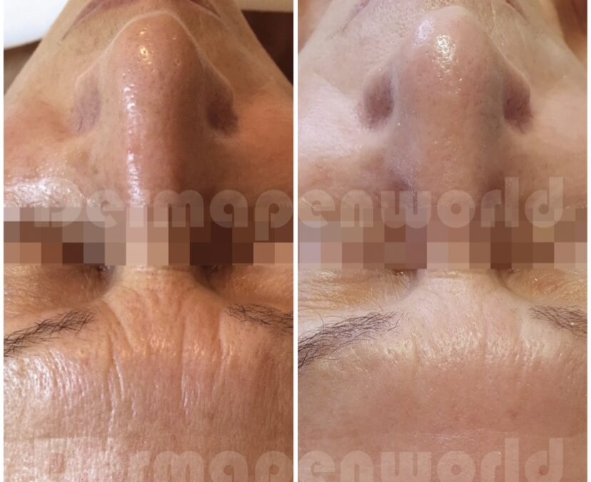 Dermapen before and after 3