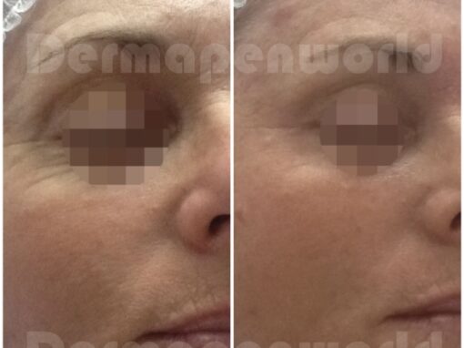 Dermapen before and after 5