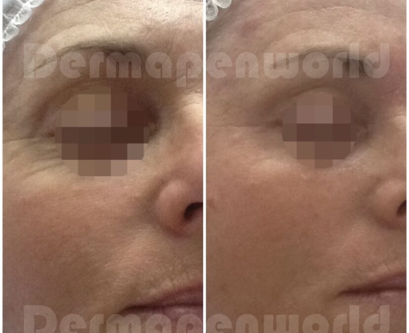 Dermapen before and after 5