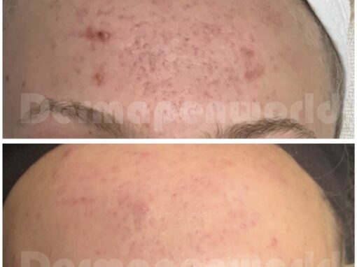 Dermapen before and after 6
