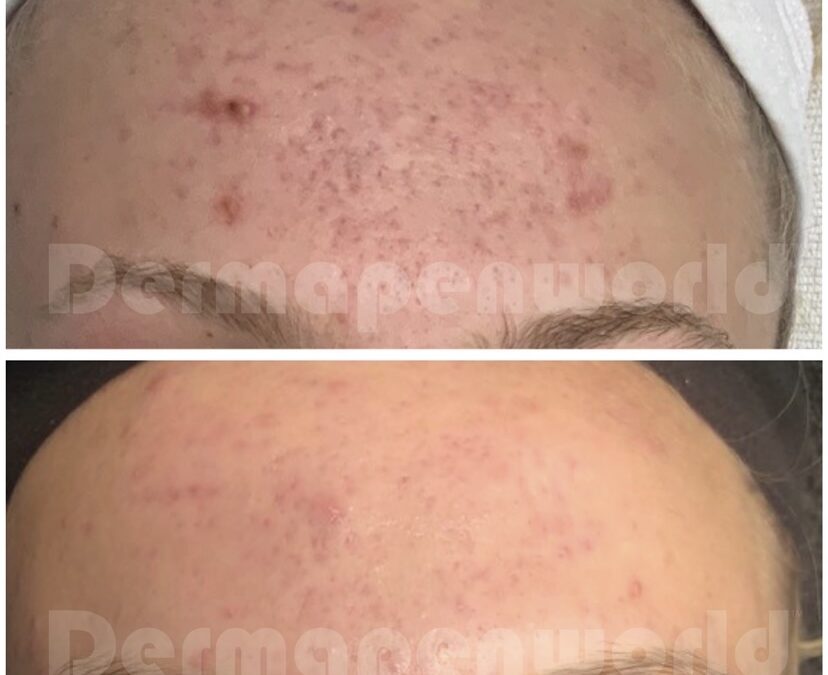 Dermapen before and after 6