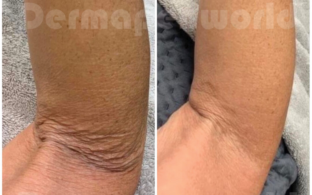 Derampen before and after 4