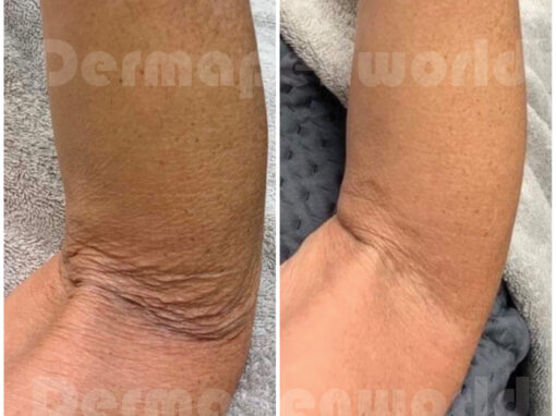 Derampen before and after 4