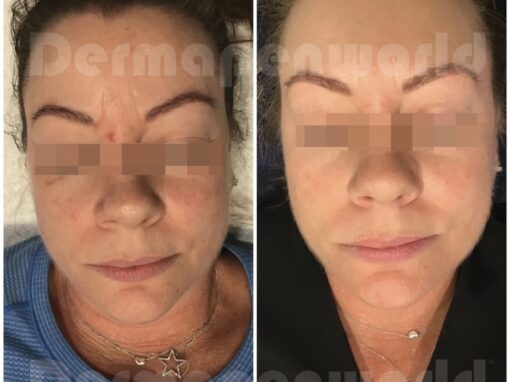 Dermapen Before & After Images 1