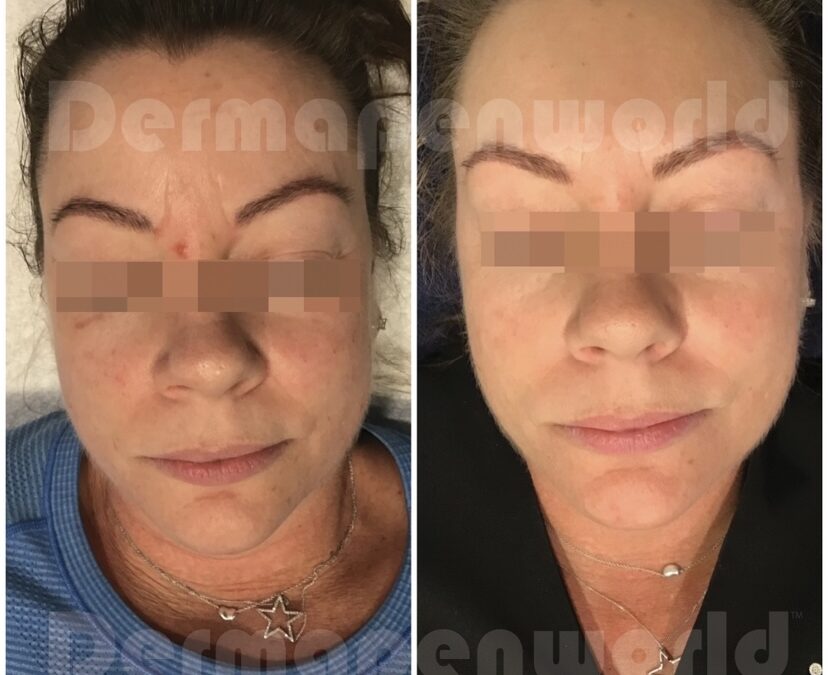 Dermapen Before & After Images 1