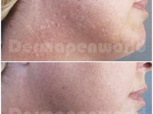 Dermapen Before and After Images 2