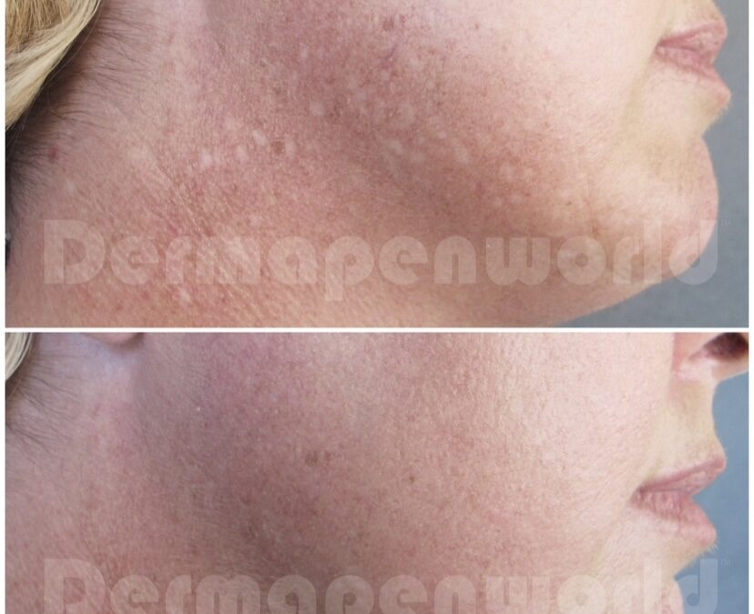 Dermapen Before and After Images 2