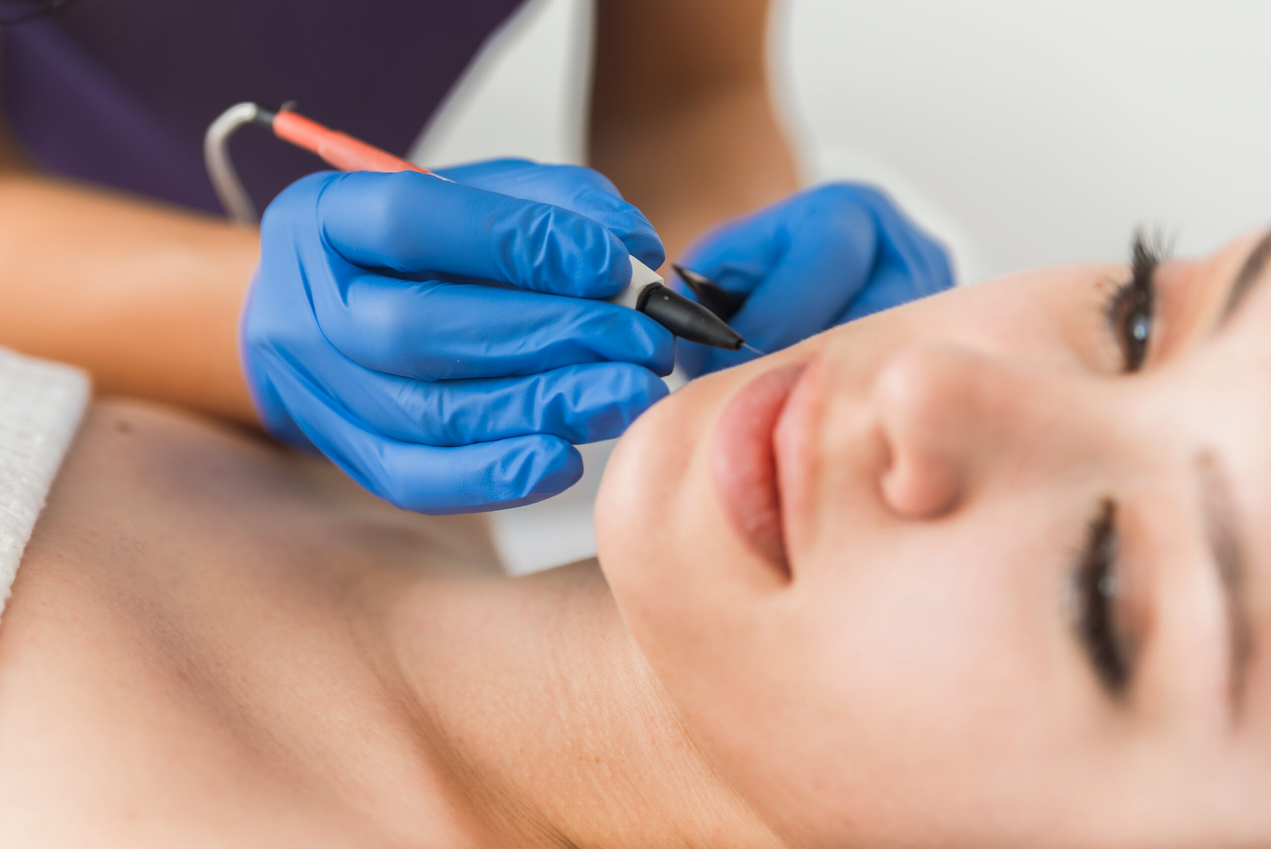 Electrolysis hair removal Essex